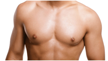 Gynecomastia