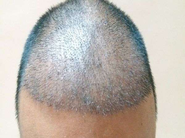 Hair Transplant in Hyderabad