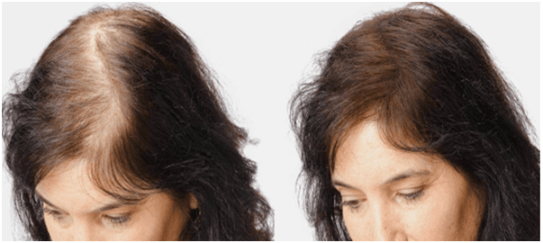 <br />
Mesotherapy Treatment in Hyderabad