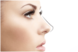 rhinoplasty