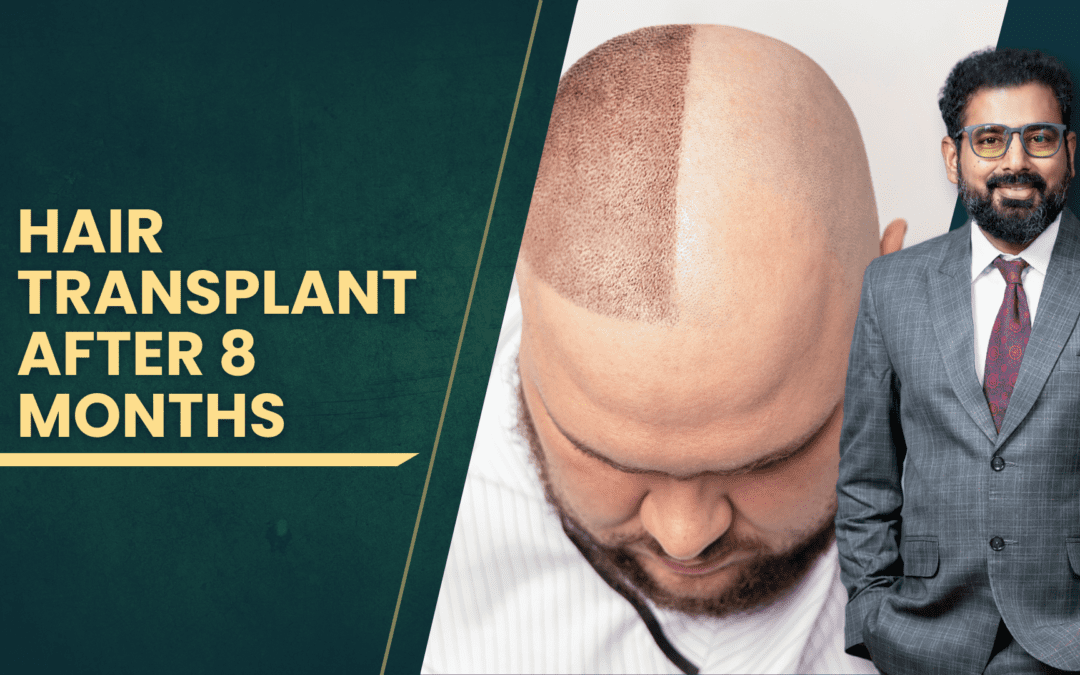 Hair Transplant After 8 Months