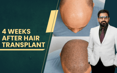 Understanding the Progress: 4 Weeks After Hair Transplant