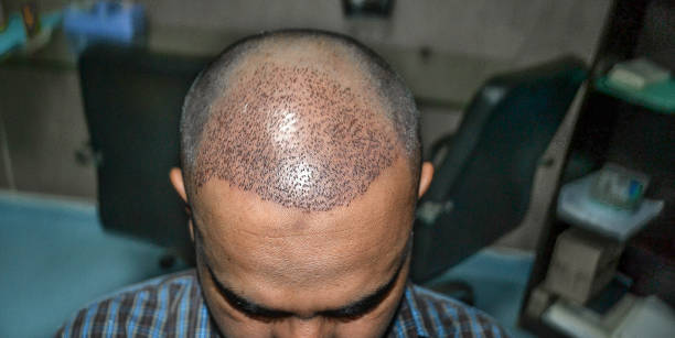 What to Expect 4 Months After Hair Transplant?