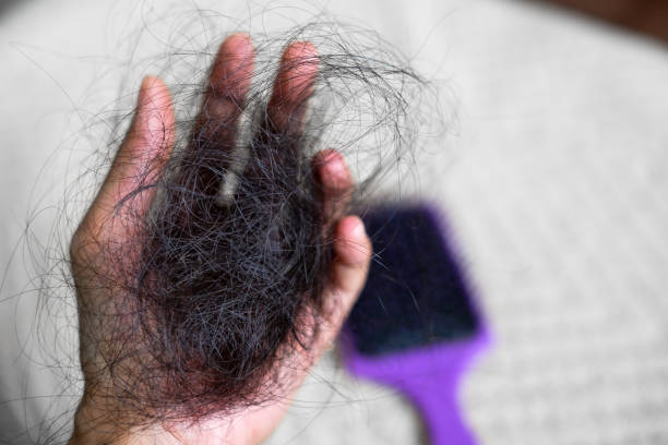 Causes of Hair Loss One Year Postpartum