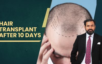 Hair transplant after 10 days