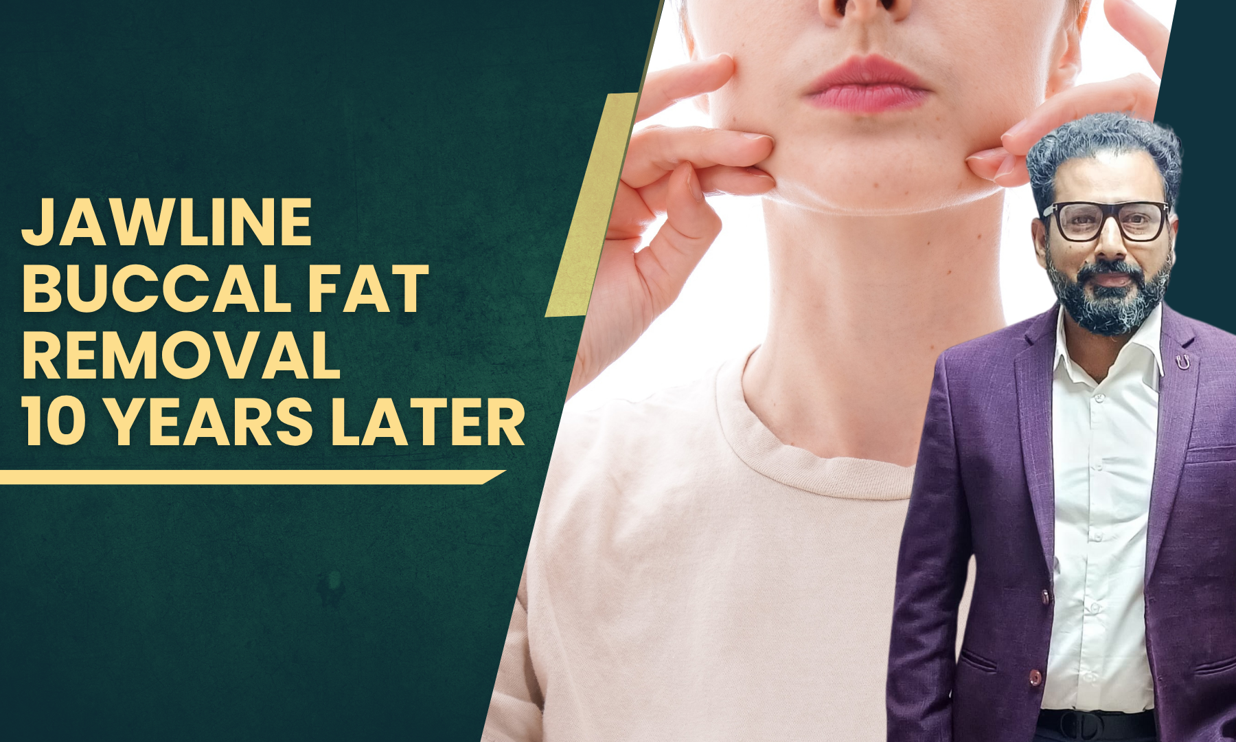 Jawline_Buccal_Fat_Removal_10_Years_Later__