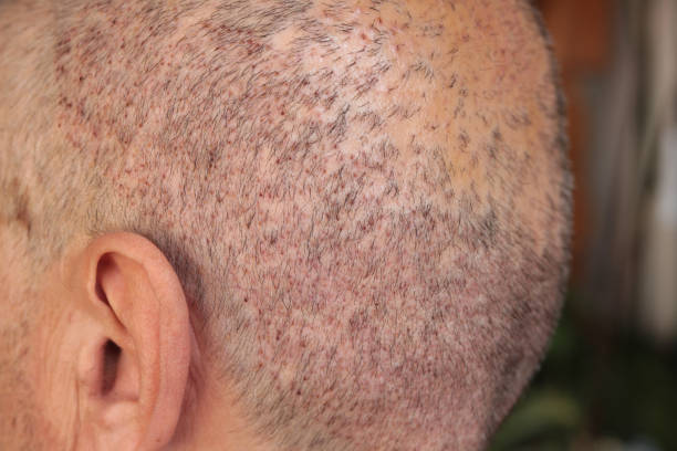 What Happens 10 Days After a Hair Transplant?