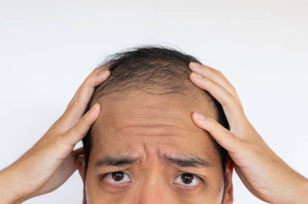 Shock loss after hair transplant Shock loss after hair transplant