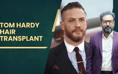 Hairline to Headlines: The Tom Hardy Hair Transplant Story