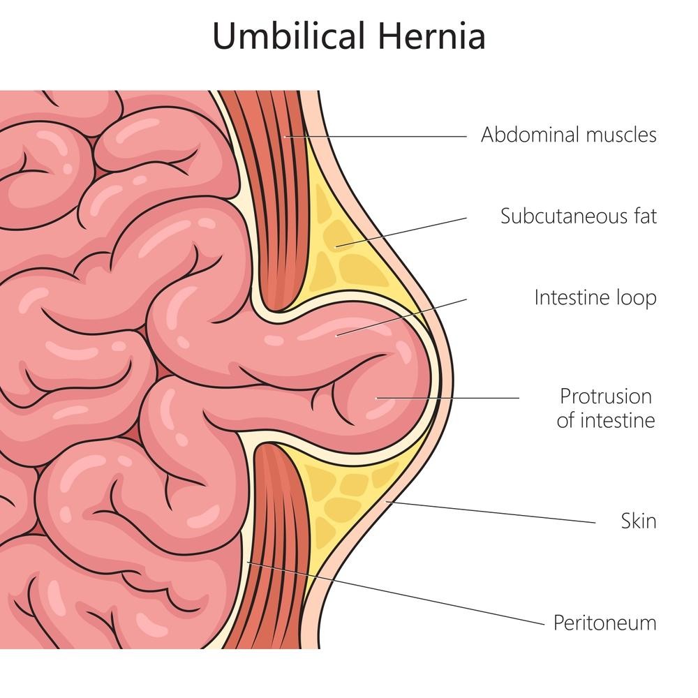 Umbilical-Hernia-new