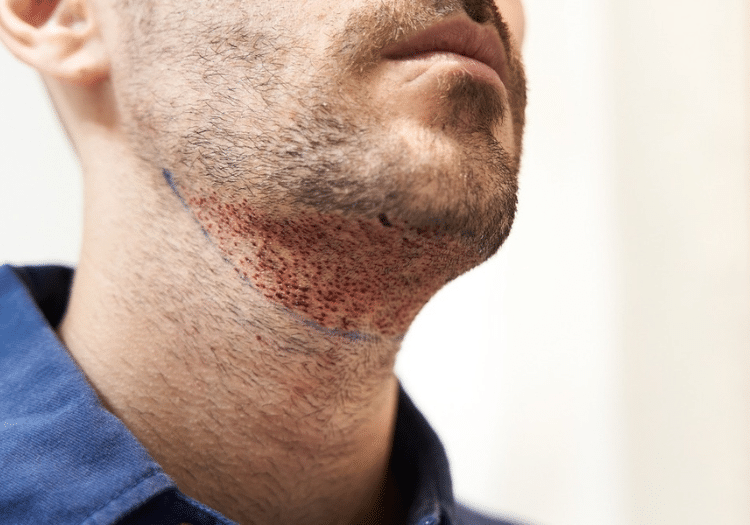 Beard Hair transplant in Hyderabad Beard Hair transplant in Hyderabad