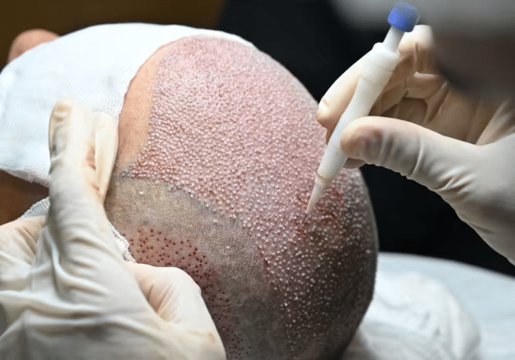 Bio FUE hair transplant in Hyderabad Bio FUE hair transplant in Hyderabad