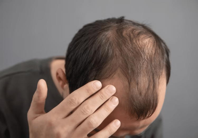 Exosomes for hair loss in Hyderabad