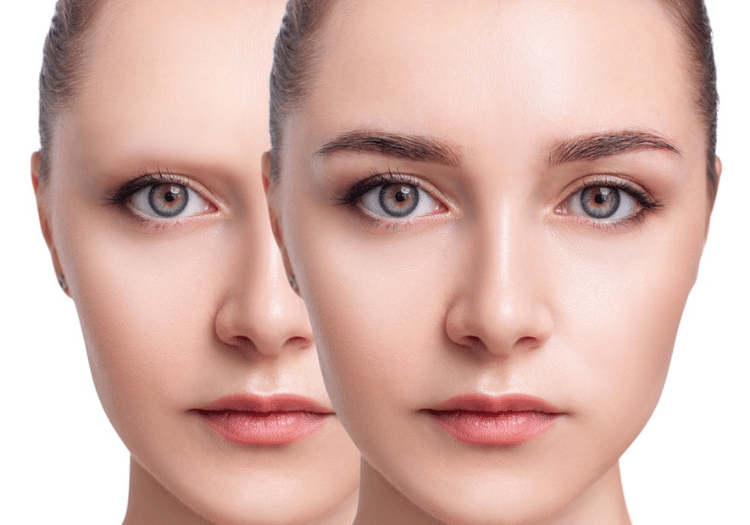 Eyebrow hair transplant in Hyderabad Eyebrow hair transplant in Hyderabad