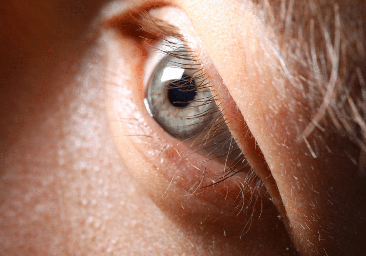 Eyelash hair transplant in Hyderabad Eyelash hair transplant in Hyderabad