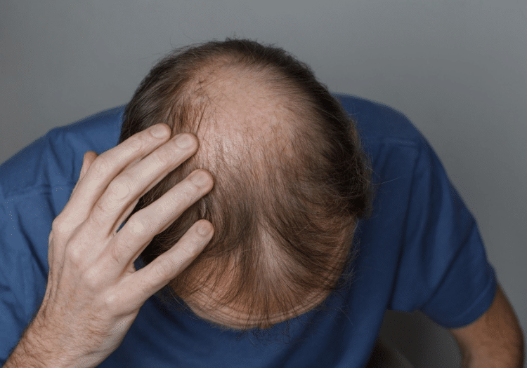 Hair loss treatment in Hyderabad Hair loss treatment in Hyderabad