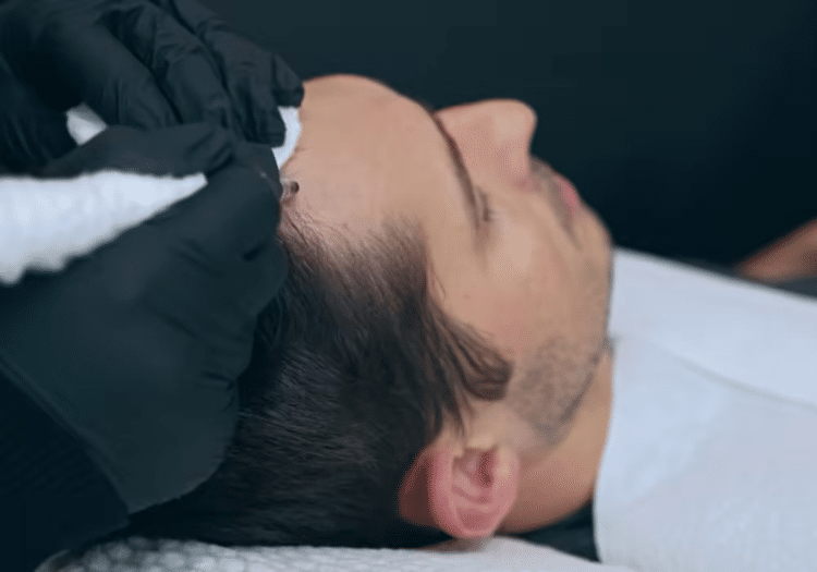 Scalp Micropigmentation in Hyderabad Scalp Micropigmentation in Hyderabad