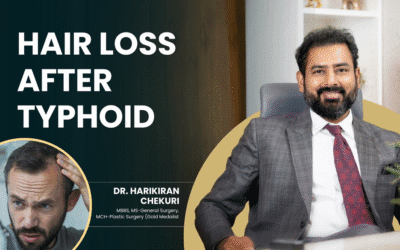 Hair Loss after Typhoid
