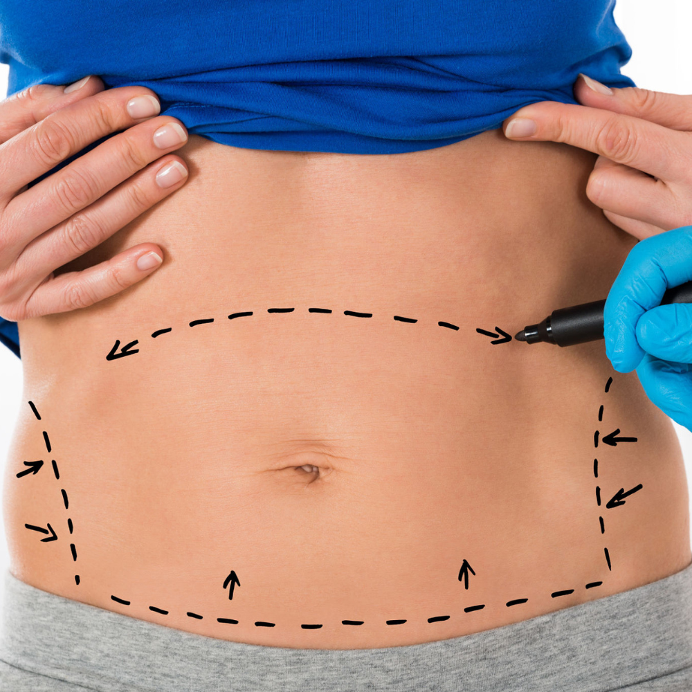 Tummy Tuck Surgery in Hyderabad