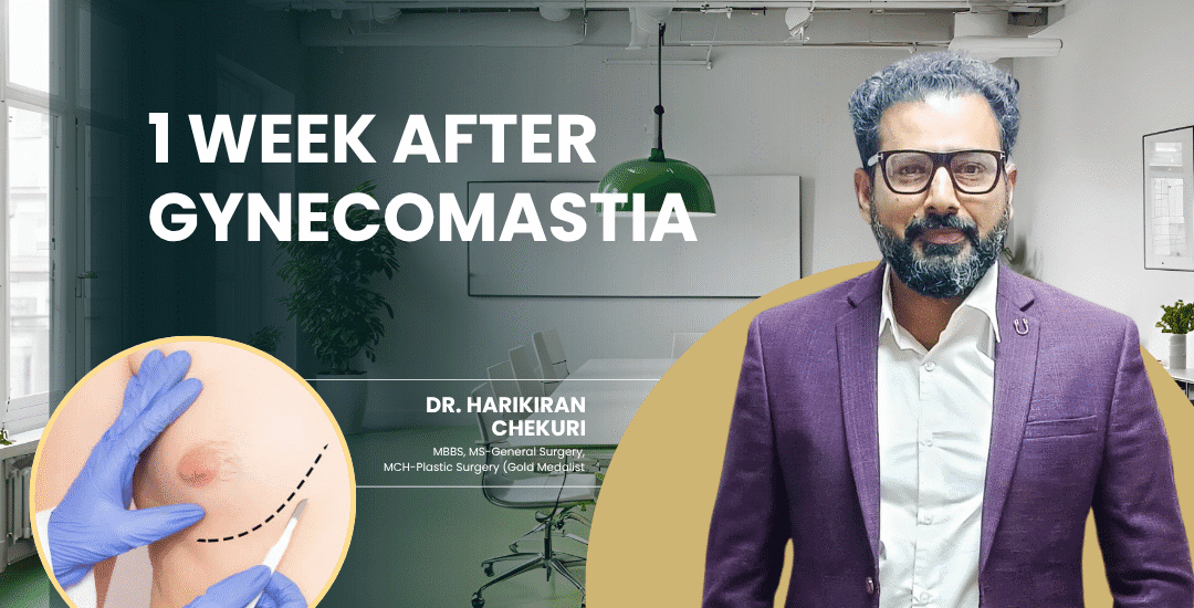 1 Week After Gynecomastia