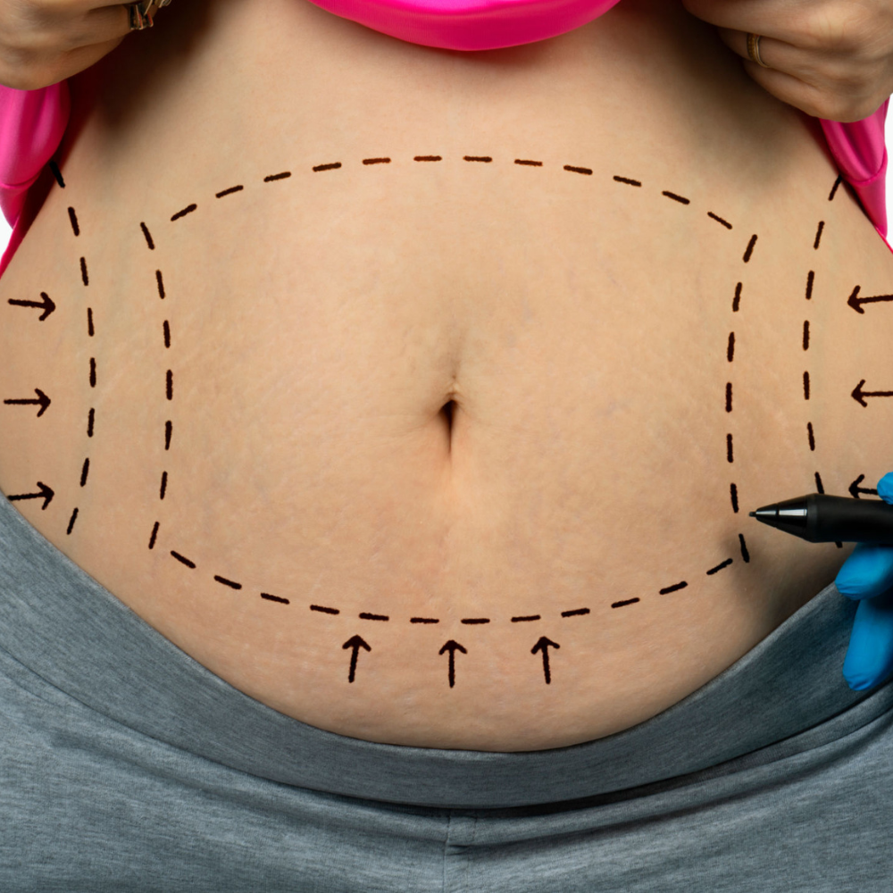 Tummy Tuck Surgery in Hyderabad