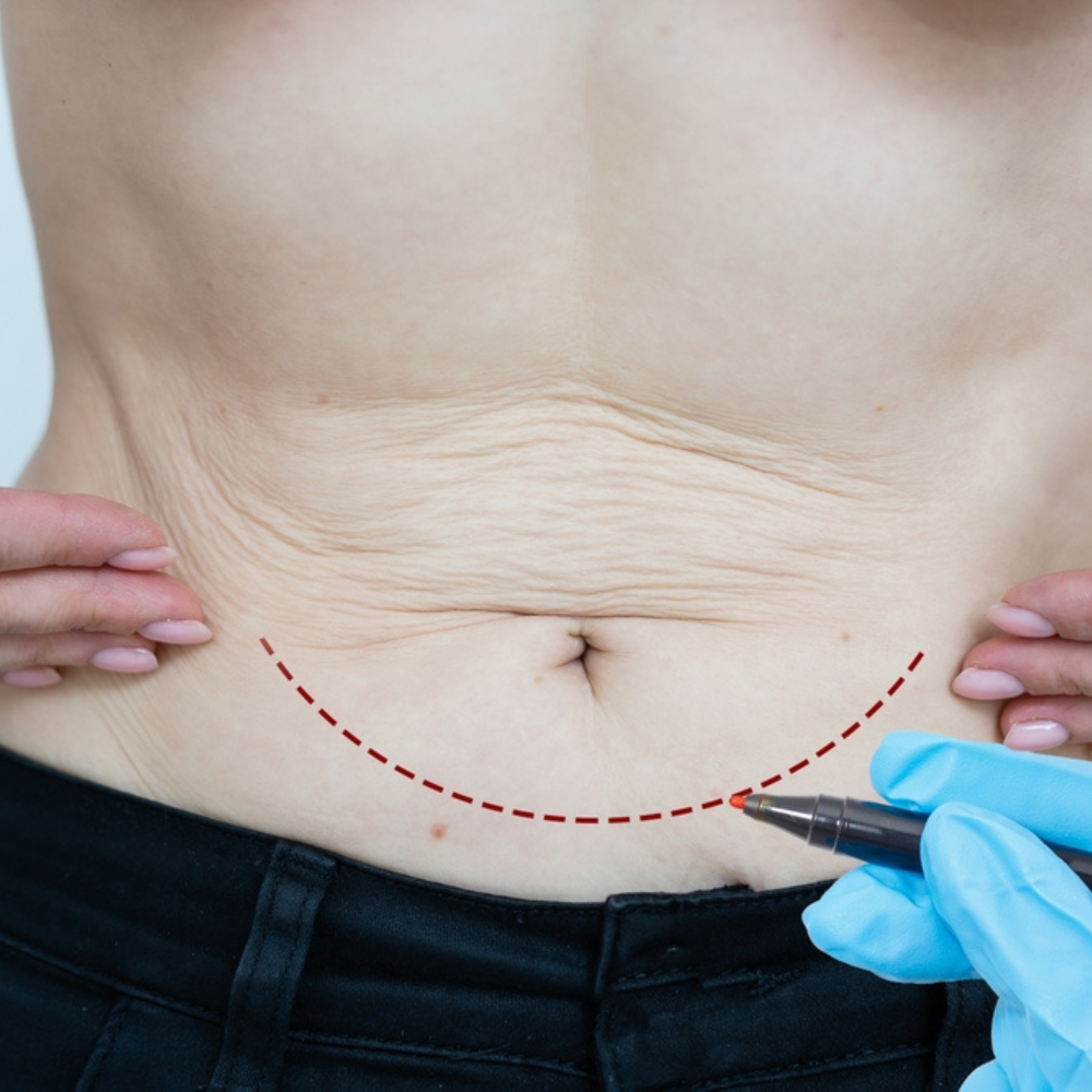 Tummy Tuck surgery in Hyderabad