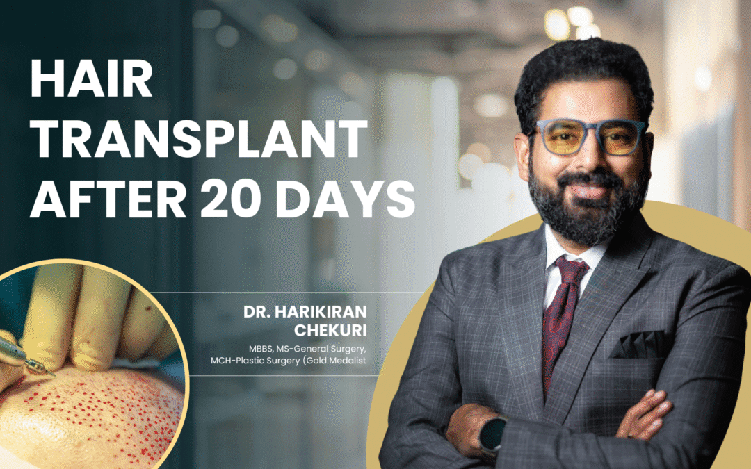 Hair transplant after 20 days