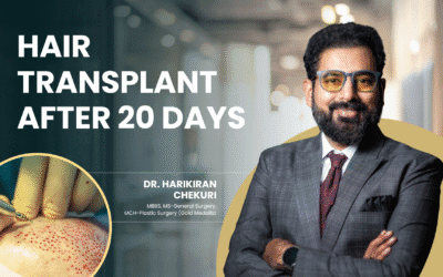Hair transplant after 20 days