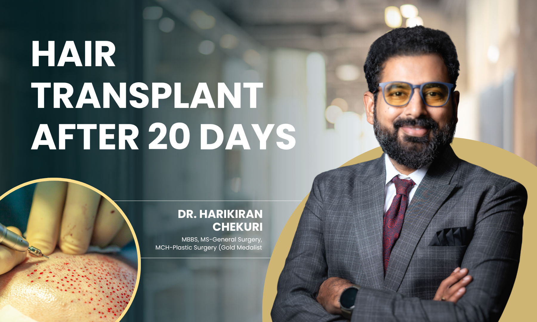 Hair transplant after 20 days