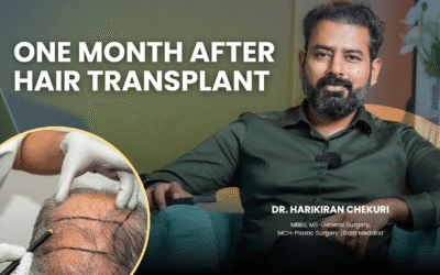 One month after hair transplant