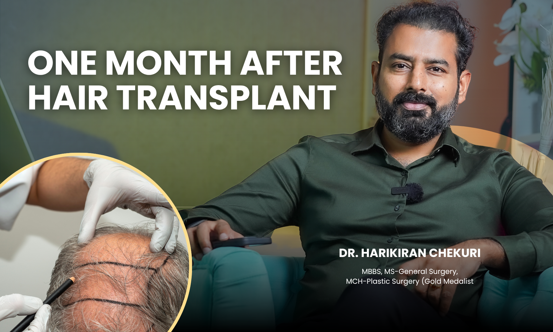 One month after hair transplant