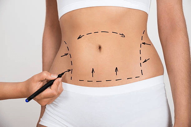 Procedure for liposuction surgery