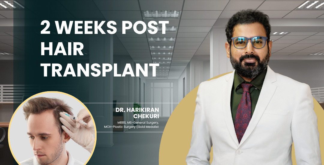 2 Weeks Post Hair Transplant