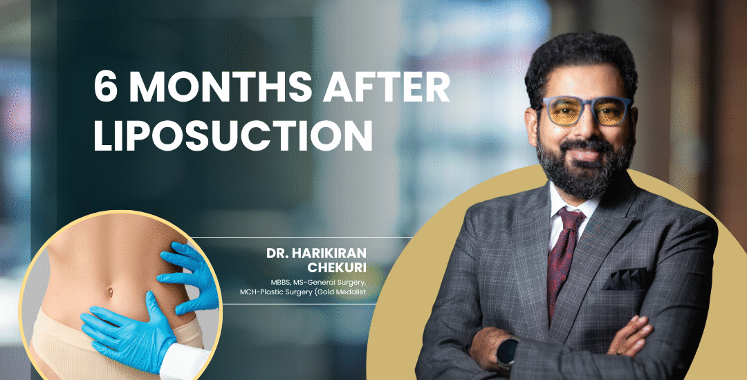 6 Months After Liposuction