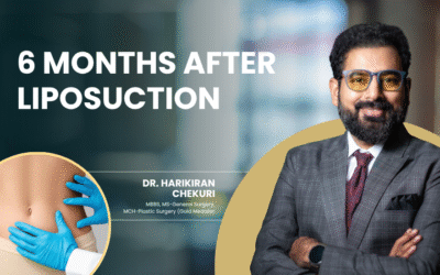 6 Months After Liposuction
