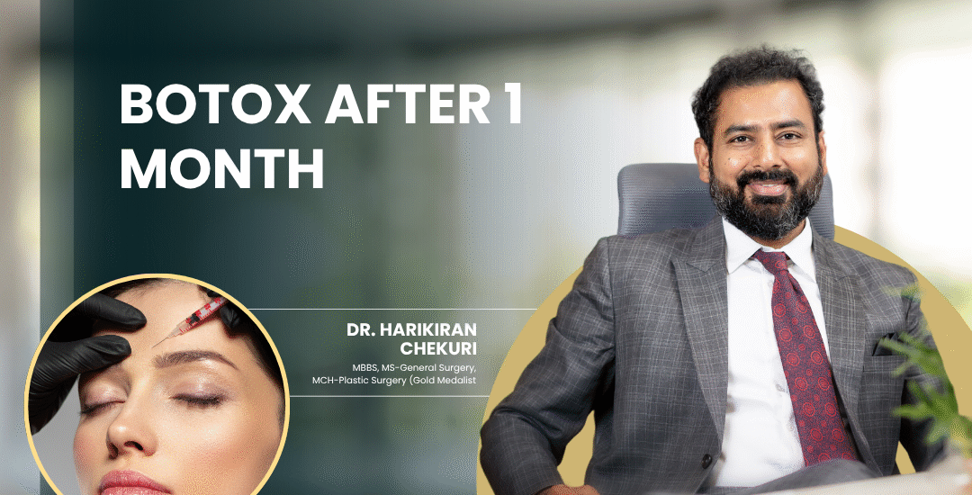 Botox After 1 Month