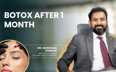 Botox After 1 Month