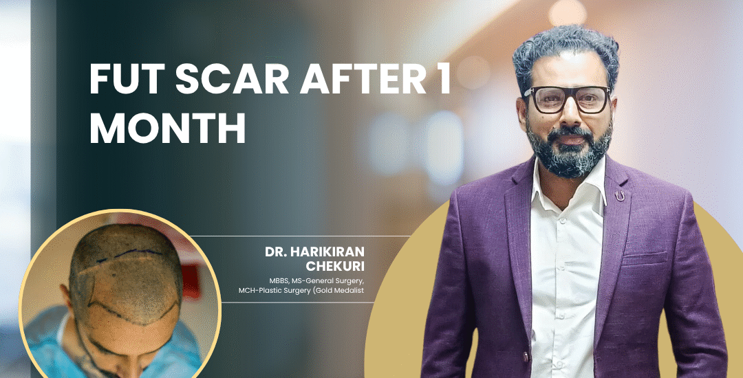 FUT Scar After 1 Month