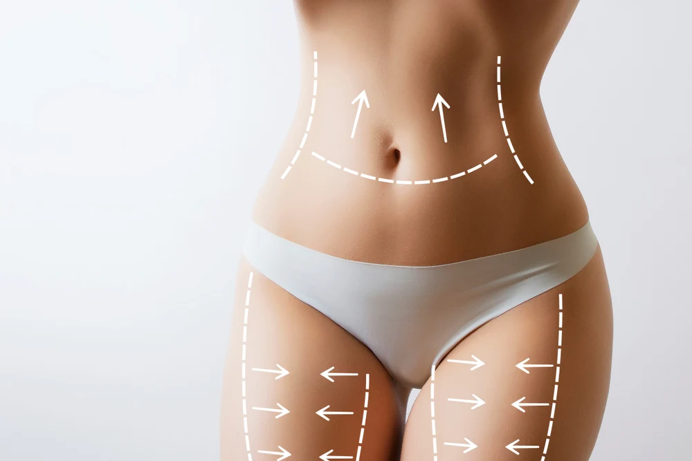 Liposuction in Hyderabad