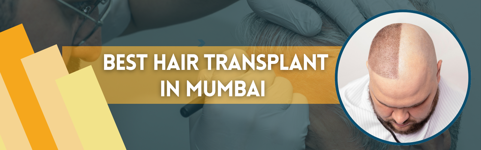 Best Hair Transplant in Hyderabad