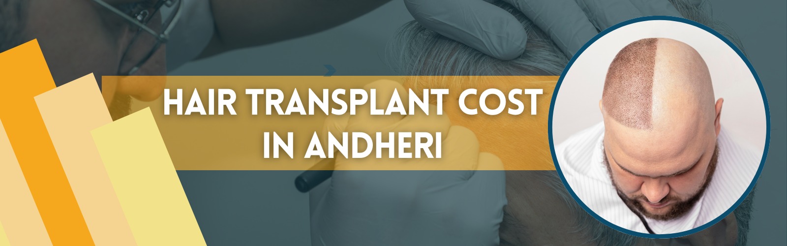 Best Hair Transplant in Hyderabad