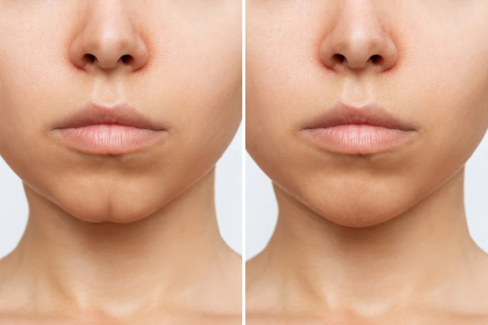 Chin Dimples | Redefine Types of Dimples