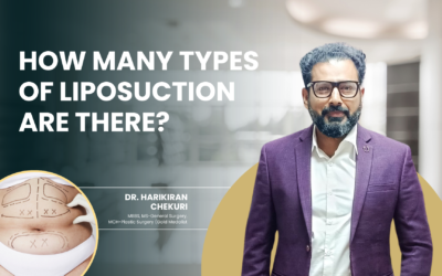 How Many Types of Liposuction Are There?
