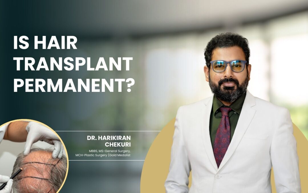 Is hair transplant permanent?