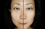 Laser Skin Whitening