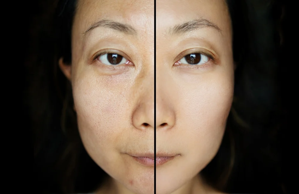 Laser Skin Whitening | Redefine Laser Skin Whitening