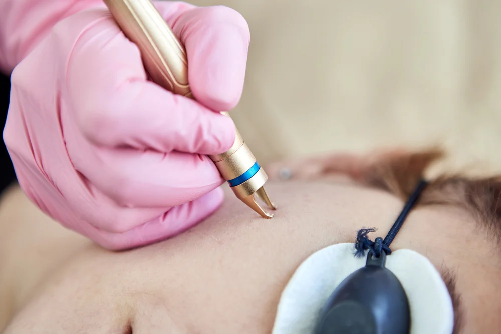 Pigmentation Correction Treatments | Redefine Pigmentation Correction