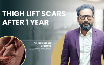 Thigh Lift Scars After 1 Year