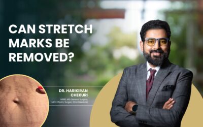 Can Stretch Marks Be Removed?