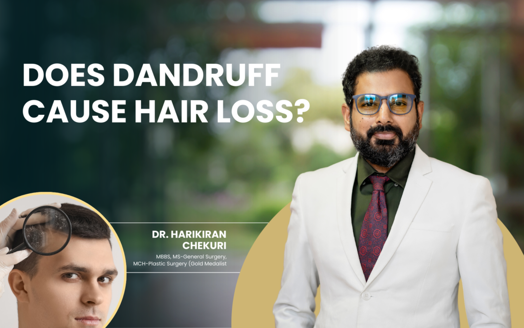 Does Dandruff Cause Hair Loss?